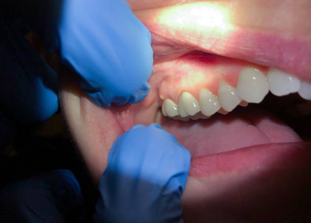 Best Emergency Dentist for Knocked-Out Tooth in Montour Falls, NY